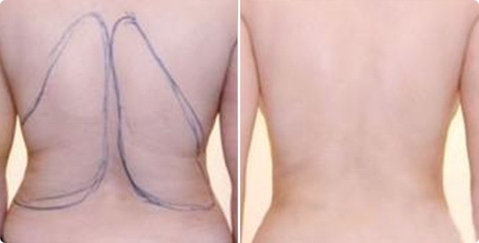 射頻溶脂瘦后背術(shù)多少錢 射頻溶脂瘦后背術(shù)后需要注意什么