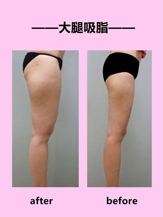 吸脂瘦大腿腫脹期是多久？大腿吸脂有什么后遺癥嗎？