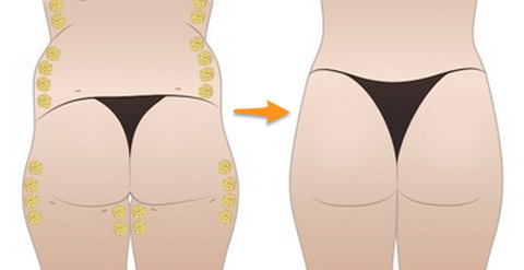 自體脂肪豐臀后會(huì)不會(huì)變形呢？自體脂肪豐臀的優(yōu)缺點(diǎn)有哪些？