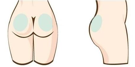 隔空溶脂瘦臀部多少錢 隔空溶脂瘦臀部術后效果怎么樣