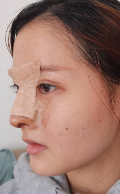 上海藝星醫(yī)療美容醫(yī)院做隆鼻手術(shù)后的第三天情況