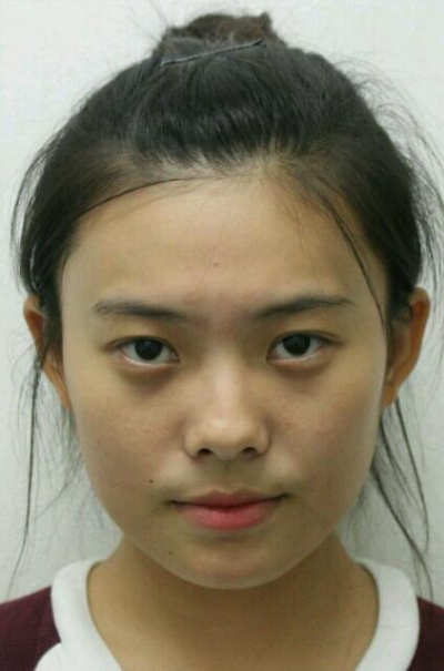 上海新健威醫(yī)療美容門診部做雙眼皮手術(shù)前的眼睛