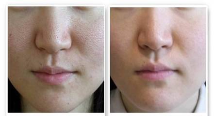 Opt嫩膚有什么功效  Opt嫩膚需要注意的事項