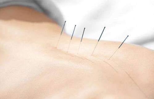 埋線減肥多少錢(qián)一次？埋線減肥多久才能有效果