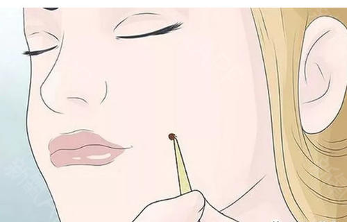 激光點痣要多久才會恢復(fù)？激光點痣多少錢？