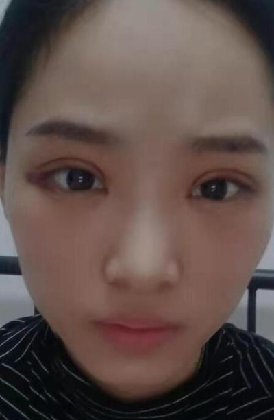  長(zhǎng)沙星雅醫(yī)療美容醫(yī)院做雙眼皮手術(shù)后恢復(fù)情況