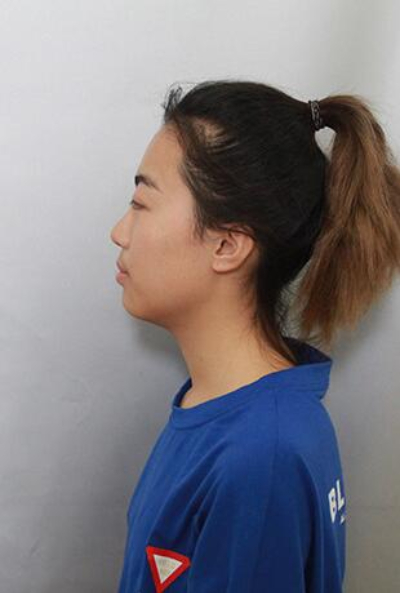  上海美萊醫(yī)療美容門診部做隆胸手術(shù)前的狀態(tài)