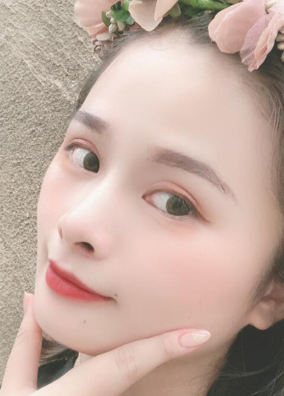 長春中妍醫(yī)療美容醫(yī)院做雙眼皮手術(shù)后第50天