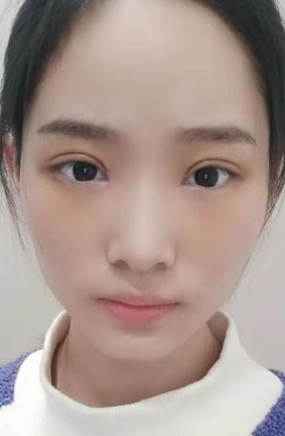  長(zhǎng)沙星雅醫(yī)療美容醫(yī)院做雙眼皮的最終手術(shù)效果
