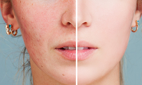 北京阿露絲醫(yī)療美容怎么樣？紅藍光祛痘紅藍光有何區(qū)別？