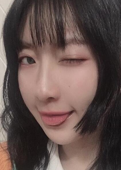 珠海陸達(dá)美容外科醫(yī)院做下頜角手術(shù)后臉的情況