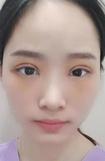  長(zhǎng)沙星雅醫(yī)療美容醫(yī)院做雙眼皮手術(shù)后的大眼