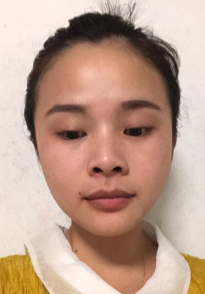 長春中妍醫(yī)療美容醫(yī)院做雙眼皮手術(shù)前的眼睛