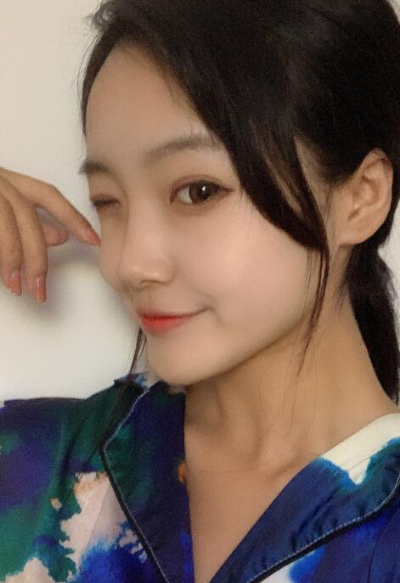 蘇州愛思特醫(yī)療美容醫(yī)院鄭曉明隆鼻案例效果分享