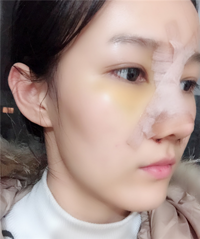 長春中妍醫(yī)療美容醫(yī)院隆鼻手術(shù)后的效果