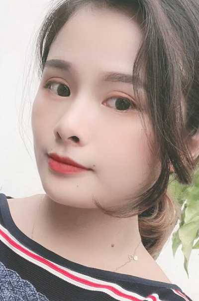 長春中妍醫(yī)療美容醫(yī)院做雙眼皮手術(shù)后第85天