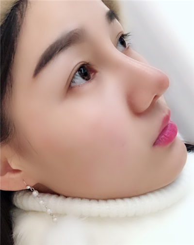 長春中妍醫(yī)療美容醫(yī)院隆鼻手術(shù)后鼻子情況基本穩(wěn)定