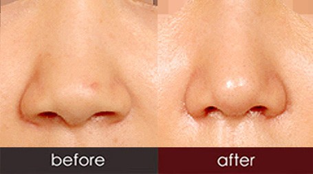 成都菲爾整形做鼻翼縮小術(shù)怎么樣？鼻翼縮小術(shù)安全嗎？