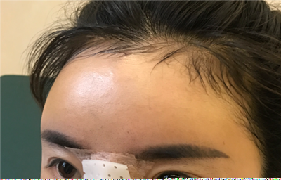 煙臺壹美整形美容醫(yī)院做隆鼻手術(shù)后的鼻子狀態(tài)