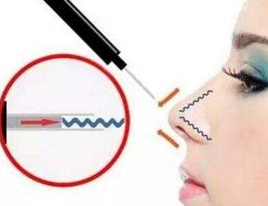 成都博雅整形埋線隆鼻有哪些優(yōu)勢？成都博雅埋線隆鼻疼嗎？