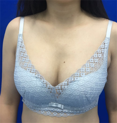 煙臺壹美整形美容醫(yī)院做隆胸手術(shù)后半個月的情形