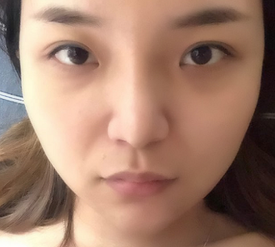 寧波尚美整形美容醫(yī)院齊強隆鼻案例效果分享