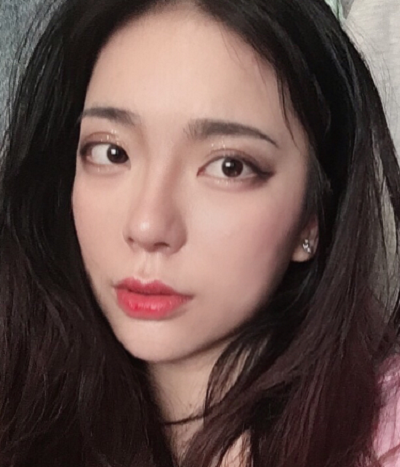 成都漢密爾頓美容醫(yī)院洪偉鼻修復(fù)案例效果分享