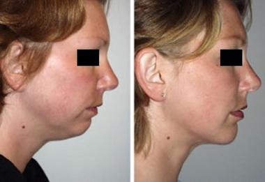 成都當(dāng)代整形透明質(zhì)酸墊下巴效果？ 透明質(zhì)酸墊下巴多少錢？