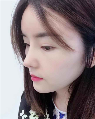 煙臺壹美整形美容醫(yī)院做隆鼻手術(shù)后整個鼻子的情形