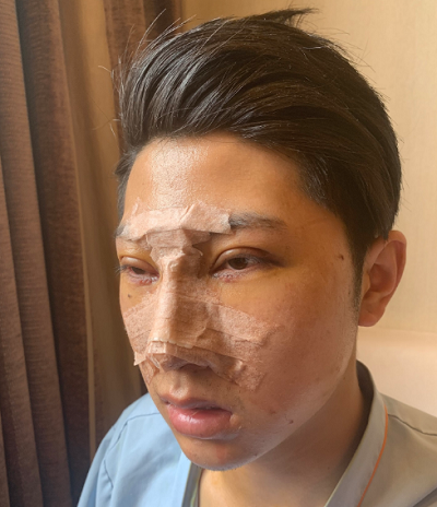 長春中妍醫(yī)療美容醫(yī)院做鼻綜合手術(shù)后