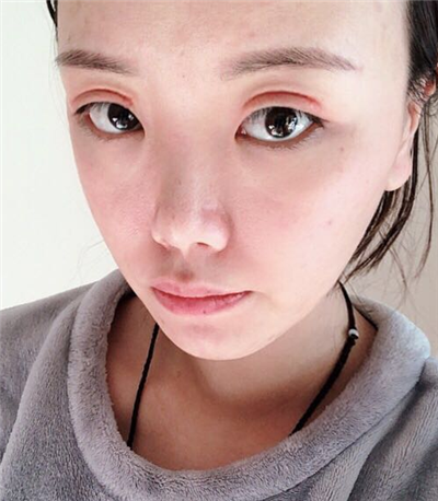 珠海韓妃醫(yī)療美容門診部做雙眼皮術(shù)后的最終情況