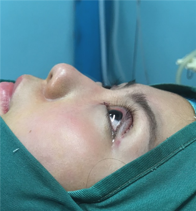 溫州友好醫(yī)院整形美容中心做雙眼皮手術(shù)剛剛結(jié)束