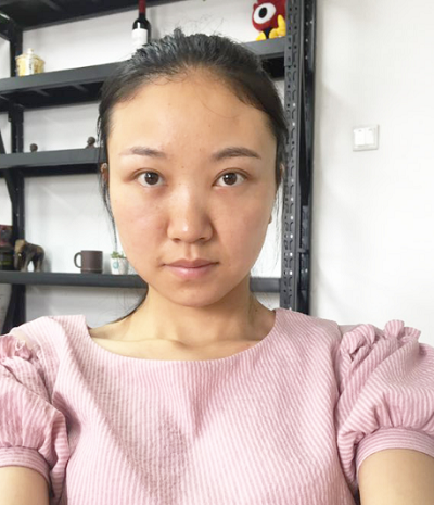 蘇州同濟醫(yī)院整形美容中心做去眼袋手術(shù)前的眼袋