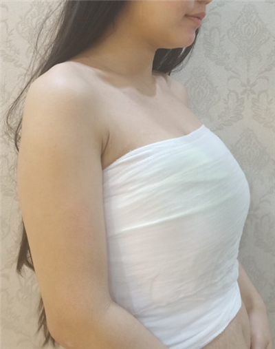 慈溪悅爾醫(yī)學(xué)美容醫(yī)院做隆胸手術(shù)前的胸部