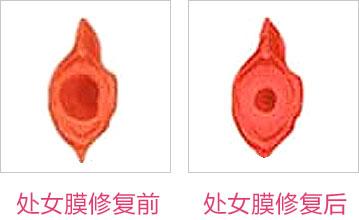成都東方整形處女膜修復怎么樣？處女膜修復術后如何護理？