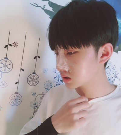 長春中妍醫(yī)療美容醫(yī)院做鼻綜合手術(shù)慢慢恢復(fù)中