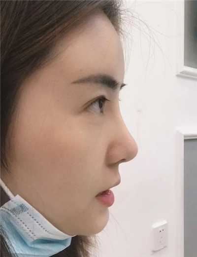 煙臺壹美整形美容醫(yī)院做隆鼻術(shù)后的最終效果