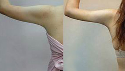  成都春語整形做手臂吸脂治術(shù)后效果好嗎？