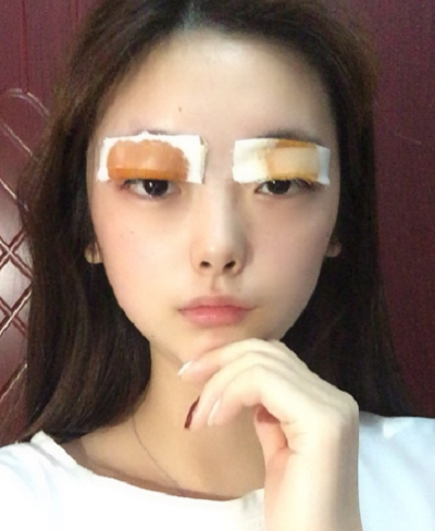 安徽韓美整形美容醫(yī)院石顯武雙眼皮案例效果分享