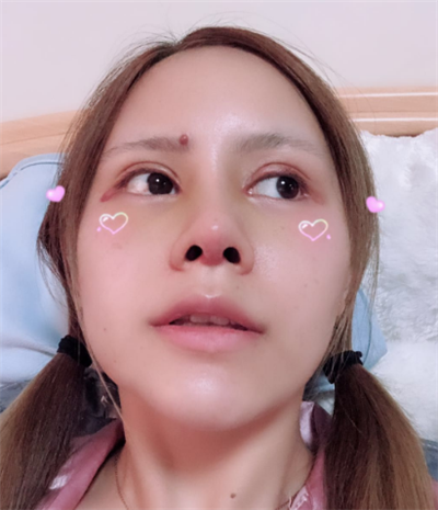 深圳弘美醫(yī)療美容門(mén)診部做眼綜合手術(shù)后的恢復(fù)情況 深圳弘美醫(yī)療美容門(mén)診部做眼綜合手術(shù)后的恢復(fù)情況