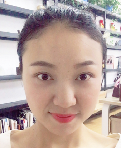 蘇州同濟醫(yī)院整形美容中心做去眼袋手術(shù)后的第15天