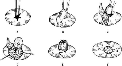 成都韓美醫(yī)療做巨乳縮小術(shù)效果如何有多少方法？