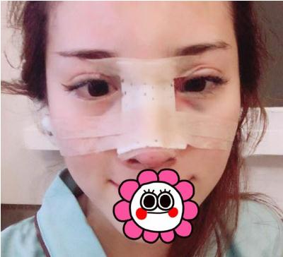 宜昌奧萊整形楊群申膨體隆鼻案例術(shù)后兩天效果