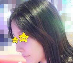 隆鼻真實(shí)案例，長(zhǎng)沙亞韓鄭京湘隆鼻前后對(duì)比圖片