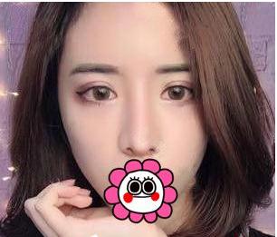 宜昌奧萊整形楊群申膨體隆鼻案例術(shù)后兩個月效果