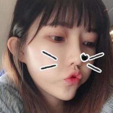 做雙眼皮案例，第四軍醫(yī)大學(xué)唐都醫(yī)院李望舟雙眼皮案例圖片