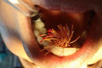 撫州英倫口腔根管治療怎么樣？根管治療有什么優(yōu)點？