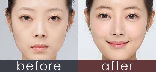 玻尿酸填充蘋果肌后效果能保持多久？想豐蘋果肌是自體好一點(diǎn)還是玻尿酸好一點(diǎn)？