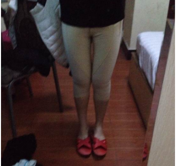  東莞華美醫(yī)療美容醫(yī)院做大腿吸脂手術(shù)后的兩個(gè)月