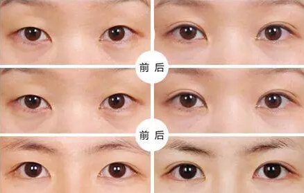 貴州旭美人整形埋線雙眼皮優(yōu)點有哪些如何選擇？